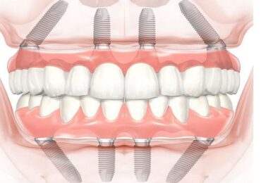 Твій впевнений старт в імплантології: майстер-клас у Каразінській школі стоматології! 